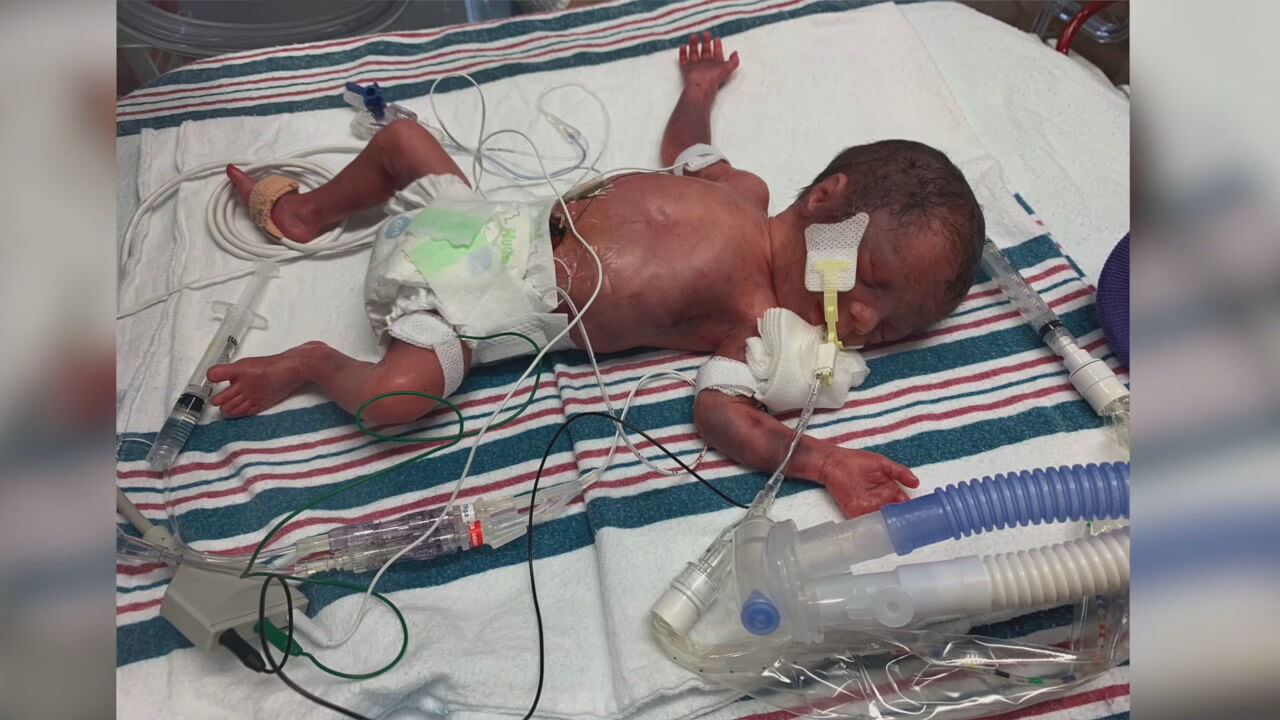 Miracle Babies - baby in NICU